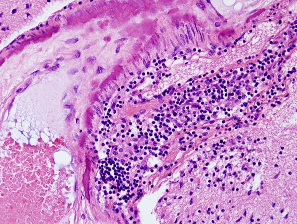 1C7 Familial erythrophagic lymphohistiocytosis (Case 1) no HIV H&E 10