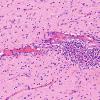 1C8 Familial erythrophagic lymphohistiocytosis (Case 1) no HIV N1 H&E 3