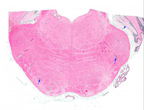 2A1 Familial erythrophagic lymphohistiocytosis (AANP 1980, Case 2) 1 H&E X0