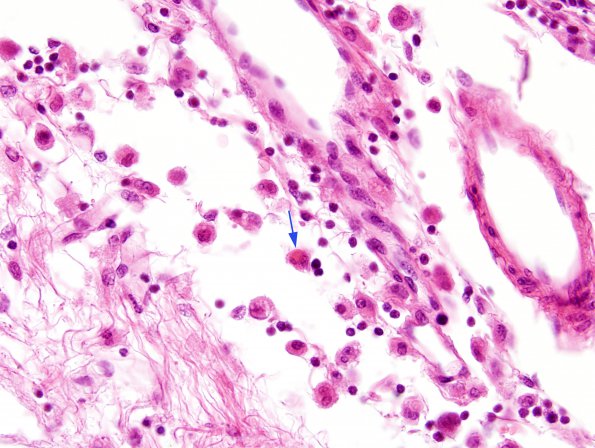 2A10 Familial Erythrophagocytic lymphohistiocytosis (AANP 1980-Case 2) H&E 8