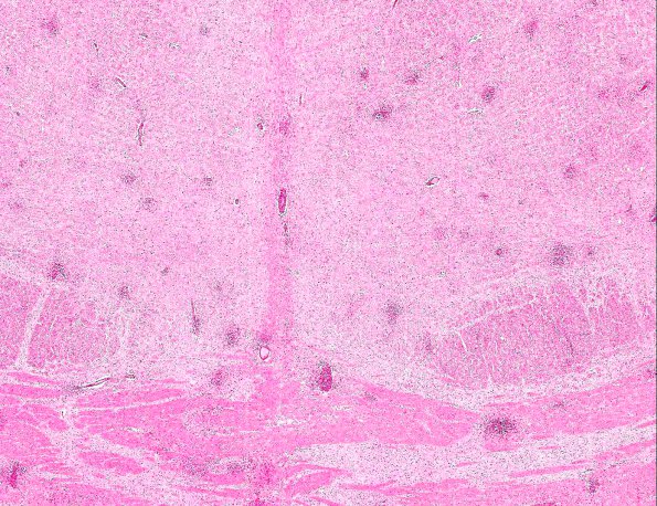 2A2 Familial erythrophagic lymphohistiocytosis (AANP 1980, Case 2) H&E X2 1