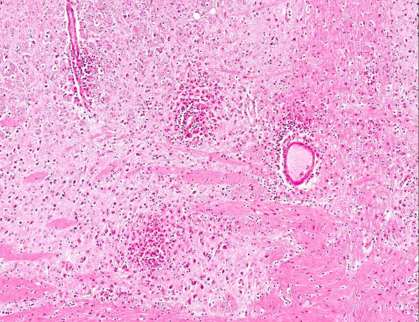 2A3 Familial erythrophagic lymphohistiocytosis (AANP 1980, Case 2) H&E X10 1