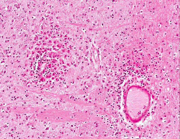 2A4 Familial erythrophagic lymphohistiocytosis (AANP 1980, Case 2) H&E X20 2