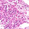 2A5 Familial Erythrophagocytic lymphohistiocytosis (AANP 1980-Case 2) H&E 1