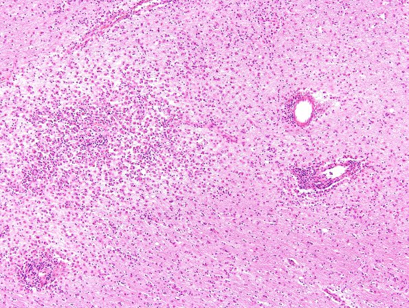 2A6 Familial Erythrophagocytic lymphohistiocytosis (AANP 1980-Case 2) H&E 2