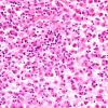 2A7 Familial Erythrophagocytic lymphohistiocytosis (AANP 1980-Case 2) H&E 4