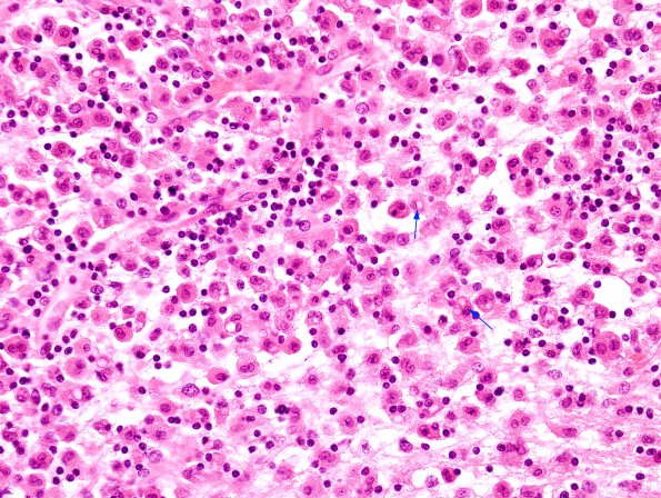 2A7 Familial Erythrophagocytic lymphohistiocytosis (AANP 1980-Case 2) H&E 4