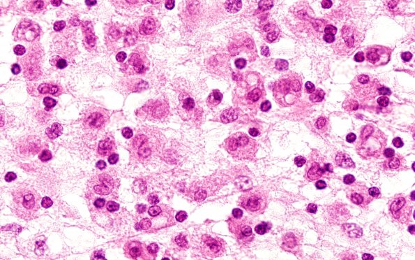 2A8 Familial Erythrophagocytic lymphohistiocytosis (AANP 1980-Case 2) H&E 4C