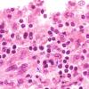 2A9 Fam Erythro Lymphohistiocytosis (AANP 1980, Case 2) H&E 100X 4AA