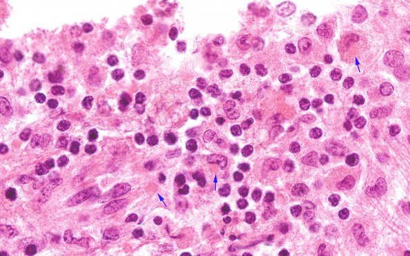 2A9 Fam Erythro Lymphohistiocytosis (AANP 1980, Case 2) H&E 100X 4AA