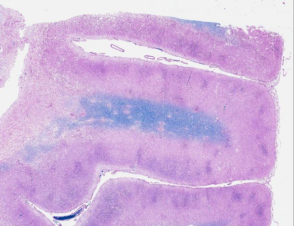 2B2 Familial erythrophagic lymphohistiocytosis (AANP 1980, Case 2) LFB-PAS X0.9