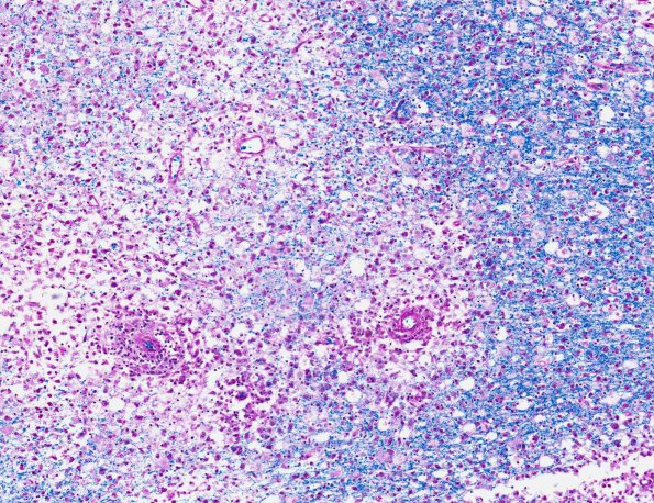 2B4 Familial erythrophagic lymphohistiocytosis (AANP 1980, Case 2) LFB-PAS X10 2