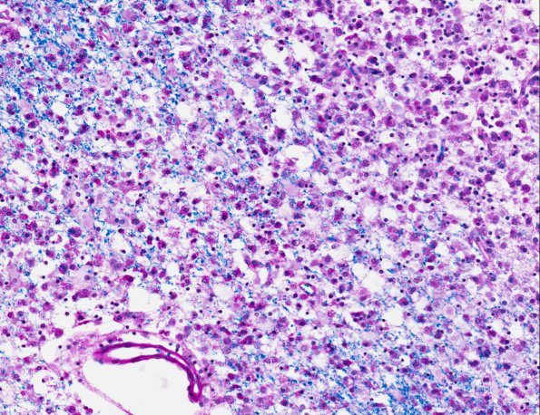 2B5 Familial erythrophagic lymphohistiocytosis (AANP 1980, Case 2) LFB-PAS X20 1