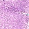 2B6 Familial erythrophagic lymphohistiocytosis (AANP 1980, Case 2) LFB-PAS 6.6X