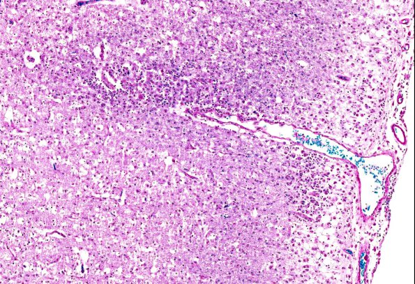 2B6 Familial erythrophagic lymphohistiocytosis (AANP 1980, Case 2) LFB-PAS 6.6X
