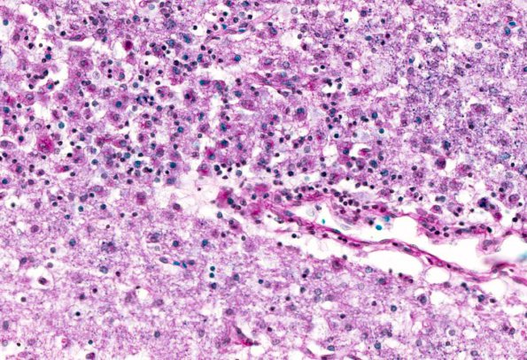 2B7 Familial erythrophagic lymphohistiocytosis (AANP 1980, Case 2) LFB-PAS 6.6X