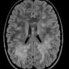 3A1 HLH (DDx ADEM) 1-27-2018 (Case 3) FLAIR 2 - Copy