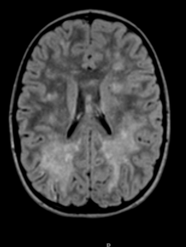 3A1 HLH (DDx ADEM) 1-27-2018 (Case 3) FLAIR 2 - Copy