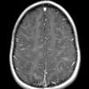 3A2 HLH (DDx ADEM) 1-27-2018 (Case 3) T1 with contrastA - Copy