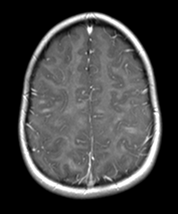 3A2 HLH (DDx ADEM) 1-27-2018 (Case 3) T1 with contrastA - Copy