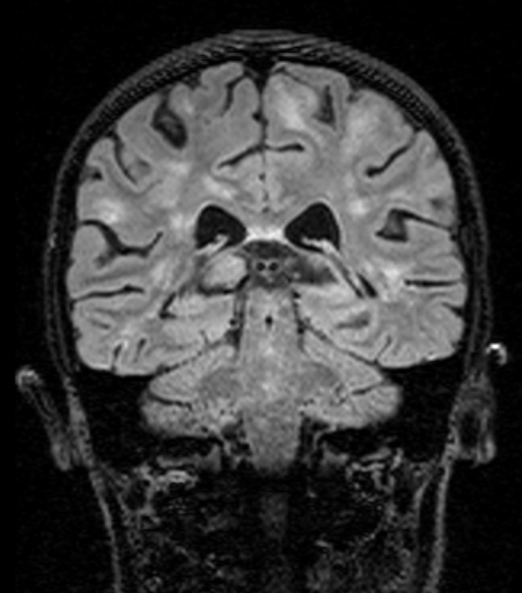 3B1 HLH (DDx ADEM) (Case 3) 6-8-2018 FLAIR 21 - Copy