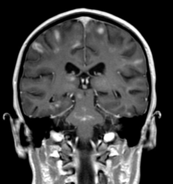 3B2 HLH (DDx ADEM) (Case 3) 6-8-2018 T1 with contrast 3 - Copy