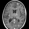 3B3 HLH (DDx ADEM) (Case 3) 6-8-2018 T1 with contrast 2 - Copy