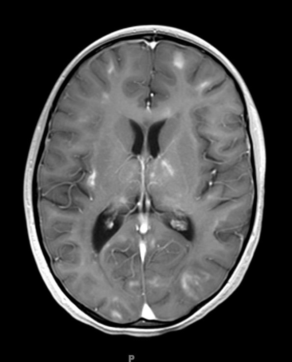 3B3 HLH (DDx ADEM) (Case 3) 6-8-2018 T1 with contrast 2 - Copy