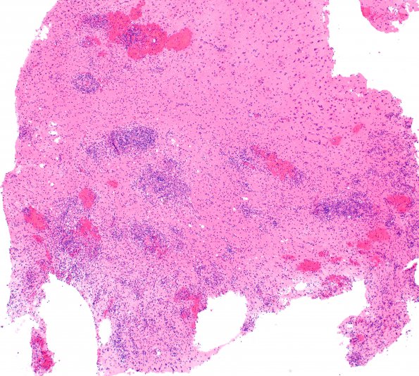 3C1 HLH, Perforin1 mutation (Case 3) A2 H&E 10X 2