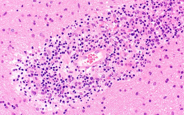 3C3 HLH, Perforin1 mutation (Case 3) H&E 19AA