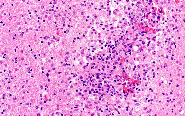 3C4 HLH, Perforin1 mutation (Case 3) H&E 10AA