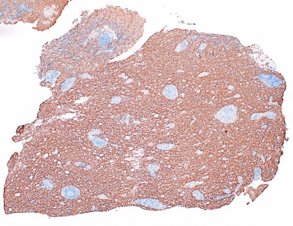 3D3 HLH, Perforin1 mutation (Case 3) NF 4X