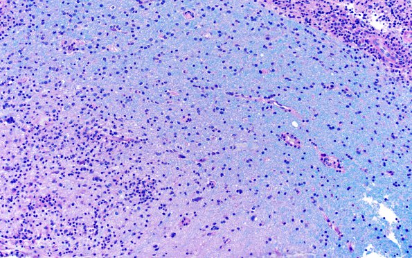 3E1 HLH, Perforin1 mutation (Case 3) area A LFB-PAS 10X