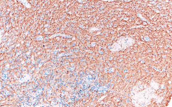 3E2 HLH, Perforin1 mutation (Case 3) area A NF 10X