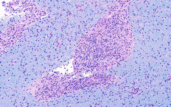 3E3 HLH, Perforin1 mutation (Case 3) LFB-PAS 1