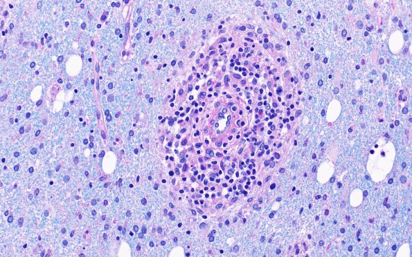 3E5 HLH, Perforin1 mutation (Case 3) LFB-PAS 3