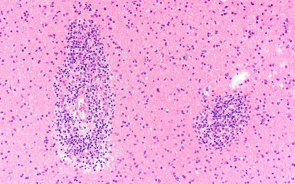 3F1 HLH, Perforin1 mutation (Case 3) H&E 21