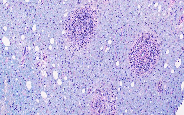 3F2 HLH, Perforin1 mutation (Case 3) LFB-PAS 4