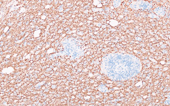 3F3 HLH, Perforin1 mutation (Case 3) NF 3