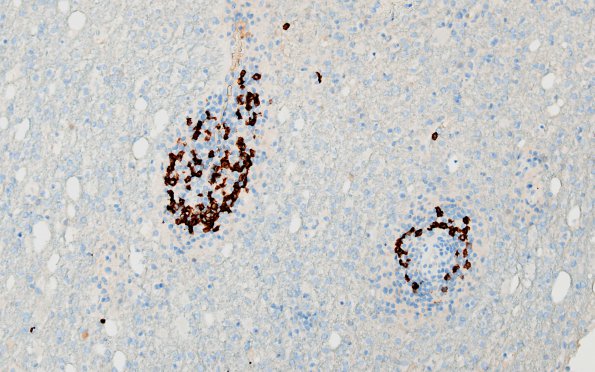 3F6 HLH, Perforin1 mutation (Case 3) CD20 4