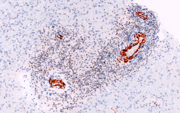 3F8 HLH, Perforin1 mutation (Case 3) SMA 1