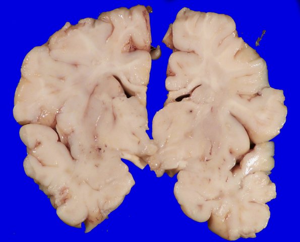 4A1 Lymphohistiocytosis (Case 4) Gross_3