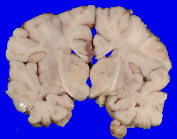 4A2 Lymphohistiocytosis (Case 4) Gross_4