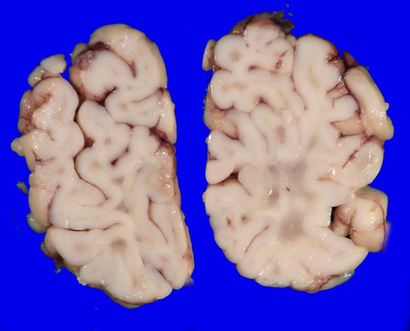 4A3 Lymphohistiocytosis (Case 4) Gross_2