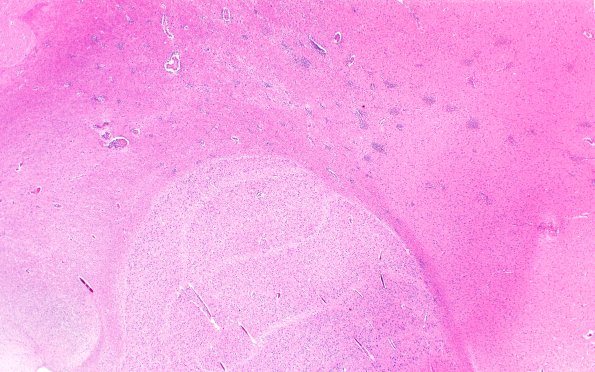 4B1 Lymphohistiocytosis (Case 4) H&E N3 2X