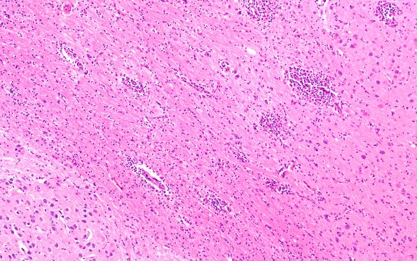 4B3 Lymphohistiocytosis (Case 4) H&E N3 10X