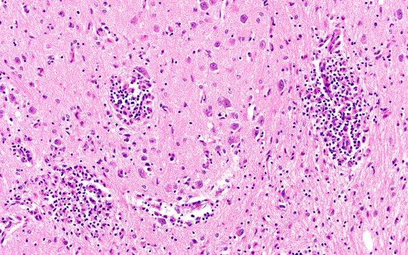 4B4 Lymphohistiocytosis (Case 4) H&E N3 20X 2