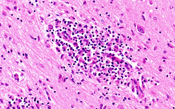 4B5 Lymphohistiocytosis (Case 4) H&E N3 40X 2