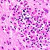4B7 Lymphohistiocytosis (Case 4) H&E N3 60X