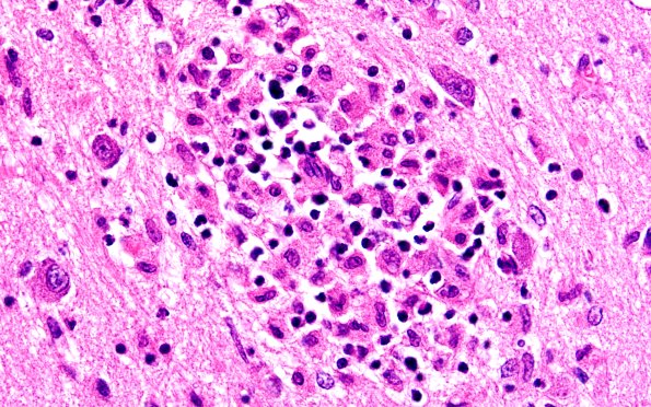 4B7 Lymphohistiocytosis (Case 4) H&E N3 60X